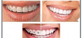 سن ارتودنسی دندان + دکتر اصلانی