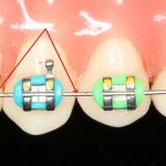 سیم ارتودنسی مسیر و نیروی لازم برای حرکت دندانها را فراهم می کند