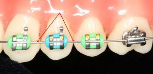 سیم ارتودنسی مسیر و نیروی لازم برای حرکت دندانها را فراهم می کند