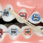 الاستیک یا کش ارتودنسی به هوک ها متصل می گردد و نیروی لازم را برای حرکت دادن دندانها را فراهم می کند