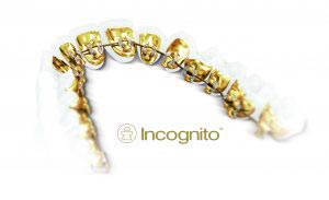 بریس پشت دندانی - لینگوال اینکاگنیتو (™Incognito)