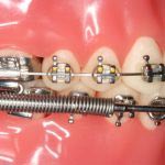 فورسوس ها جزو ابزارهای فنری ارتودنسی هستند که با نیروی مداوم خود به حرکت دندانها کمک می کنند