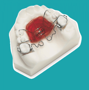 با اضافه کردن یک پیچ بسط دهنده در اکریل پندولوم، دستگاه پندکس (Pendex) ساخته می‌شود. این ابزار همراه با distalization مولرمی تواند باعث توسعه قوس دندان بالا نیز شود.
