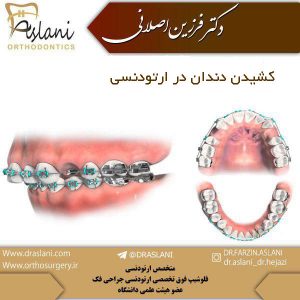 کشیدن دندان در ارتودنسی - دکتر اصلانی