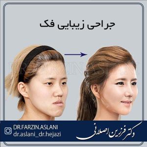 جراحی زیبایی فک - دکتر اصلانی