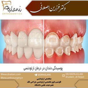 پوسیدگی دندان در درمان ارتودنسی - دکتر اصلانی