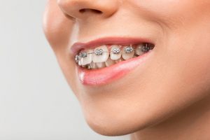 پوسیدگی دندان در درمان ارتودنسی